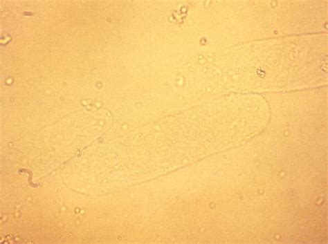 Urine Sediment Analysis Flashcards | Quizlet