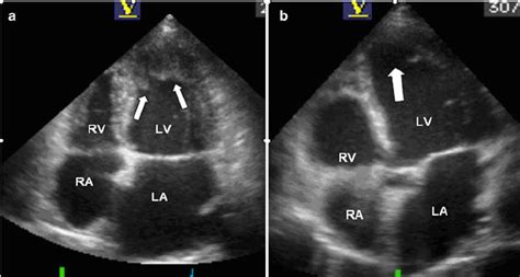 Control Echocardiographic Examination Reveals Regression In The Apical