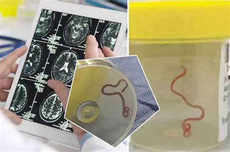 Australian Surgeon Finds 8 Centimeter Long Live Worm In Woman S Brain