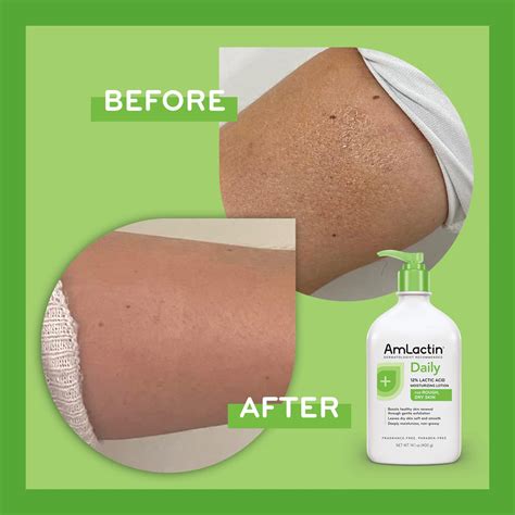 Amlactin Moisturizing Body Exfoliator and Lotion with 12% Lactic Acid