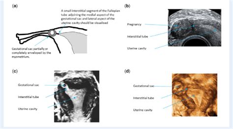 Interstitial Tubal Ectopic Pregnancy A Schematic Diagram B 2d
