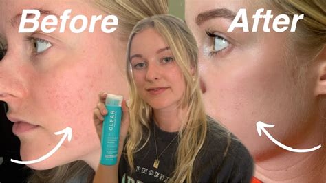 The Best Exfoliator You Need To Try For Rosacea Sensitive Skin