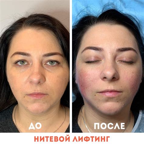 Лицо после нитей: осложнения - синяки, фиброз, реабилитация, польза ...