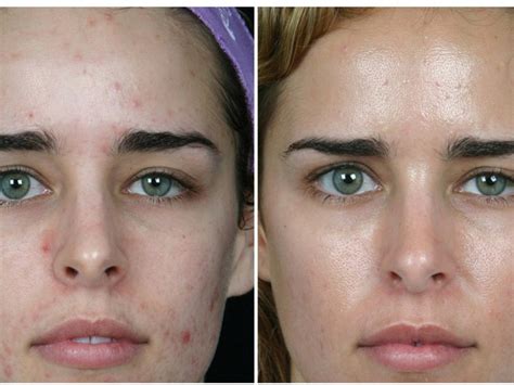 Ультразвуковая чистка лица: описание процедуры и показания