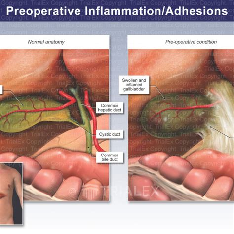 Preoperative Inflammation Adhesions Trialquest Inc