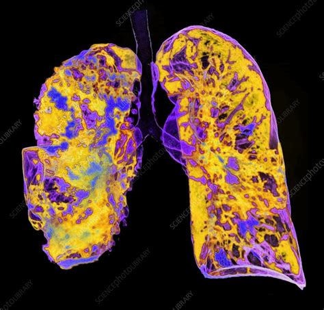 Pneumonia D Ct Scan Stock Image F Science Photo Library