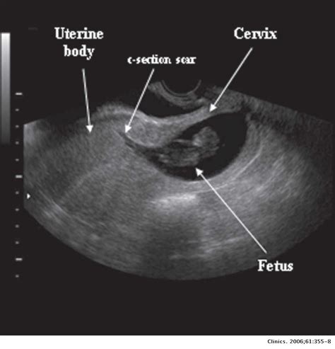 Three Dimensional Ultrasonographic Diagnosis Of A Cervical Pregnancy