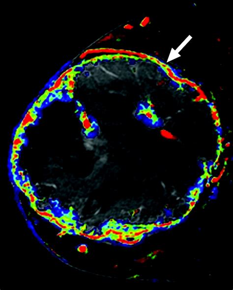 Imaging Features Of Primary Breast Sarcoma Ajr