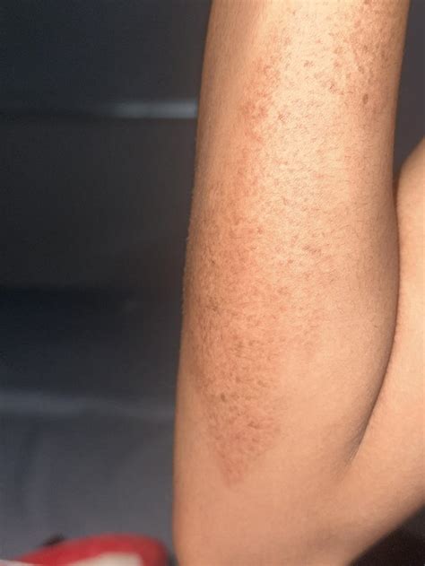 Road Rash Scar Rdermatologyquestions