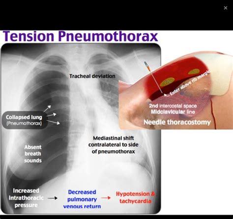 Chapter Pneumothorax Hemothorax Chest Tubes Flashcards Quizlet