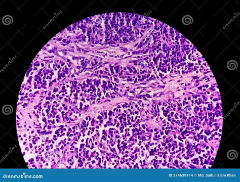 Photomicrograph Of Stained Slide Of Histology A Slide Of Malignancy