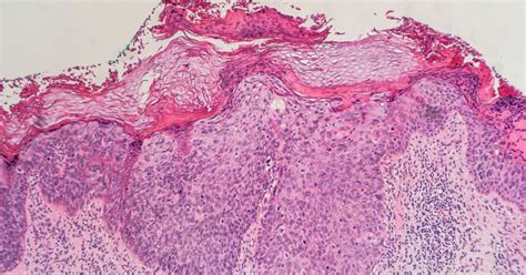 Symptoms And Treatments For Bowens Disease Facty Health