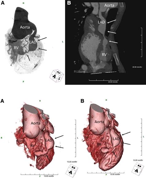 Figure 2 From Giant Pulsatile Coronary Aneurysms Associated With