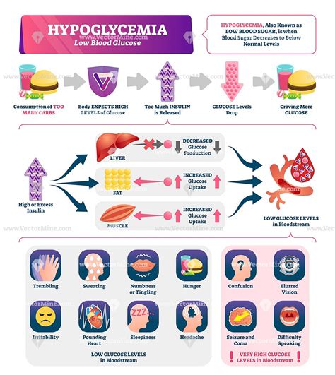 Hypoglycemia Infographic Vector Illustration Hypoglycemia Brain