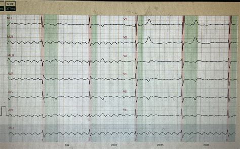 Practice Case -- A 50yo presented with bradycardia. What do you think ...