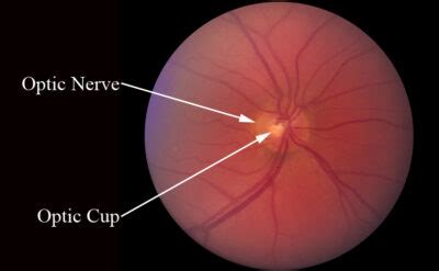 Optic Nerve Cupping - Causes, Reversal, And Treatment