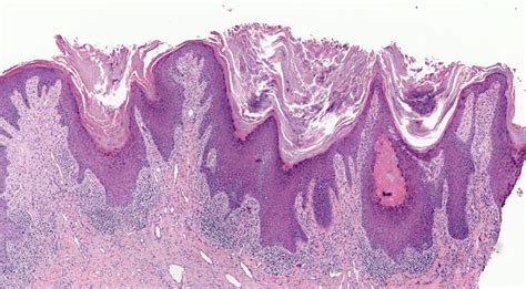 Pathology Outlines Lichen Planus 20928 Hot Sex Picture