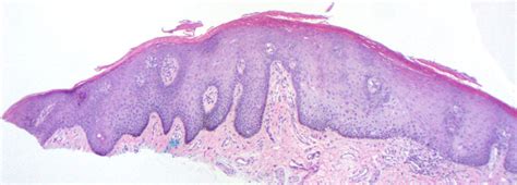 Labial Lentigo Labial Melanotic Macule