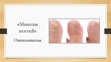Грибковые инфекции и противогрибковая терапия - презентация онлайн