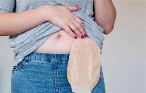 What Are The Long Term Side Effects Of A Colostomy Reversal