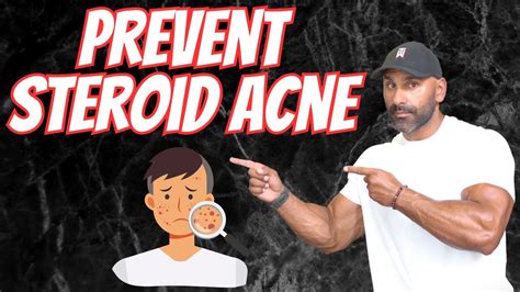 Steroid Acne How To Prevent It Youtube