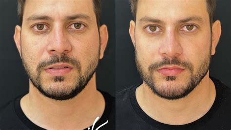 Como a harmonização facial é feita? Entenda o procedimento | O Bom da ...