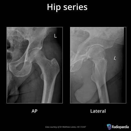 Pelvis Lateral View X Ray