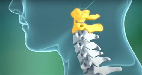 atlantoaxial instability definition spine info