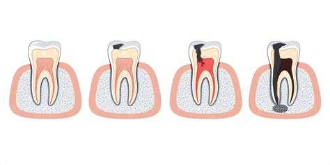 Ilustración De Dientes Dañados Dientes Dañados Ilustración De Vectores De Dentista Cuidado