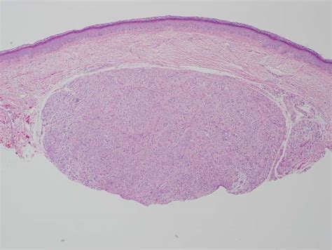 Palisaded Encapsulated Neuroma (Neuroma [PEN and traumatic], Solitary ...