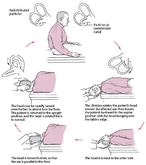 Epley Maneuver Illustration