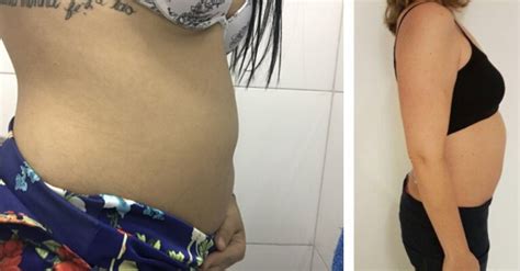 O Que Pode Ser Estomago Alto - Estômago alto: conheça as causas, sintomas e tratamentos