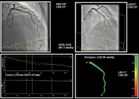 angiography based ffr reevaluating  role   pressure wire