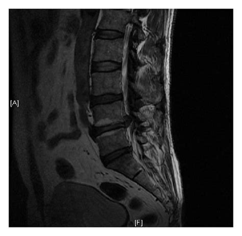 T2 Sagittal A And Axial B Mri Show Contralateral Reherniation T2