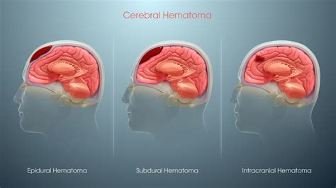 Hematoma Intracraneal Hematomas Intracraneales Hematoma Epidural Se