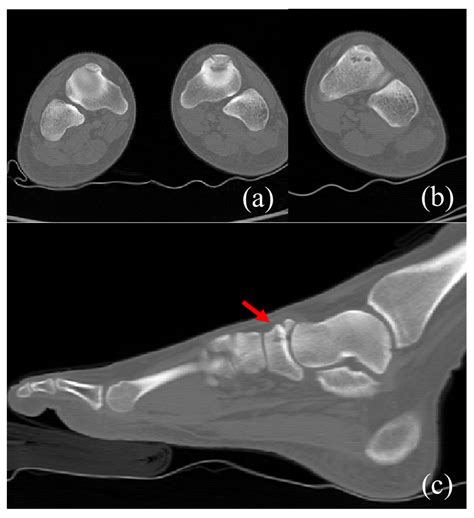 Medicina Free Full Text Treatment Of Navicular Stress Fracture