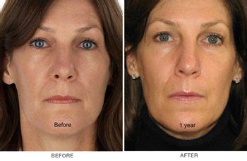 Vampire Facelift using PRP for a youthful you | Face R-X Medspa