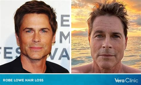 Rob Lowe Hair Loss From Iconic 80s Hair To Hollywood Success