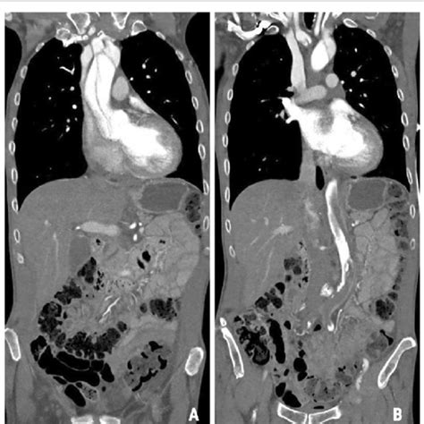 Aortic Dissection Type A A With Subtotal Occlusion Of The Descending