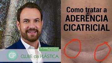 O Que É Aderencia Em Cirurgia - Como resolver aderência de cirurgia?