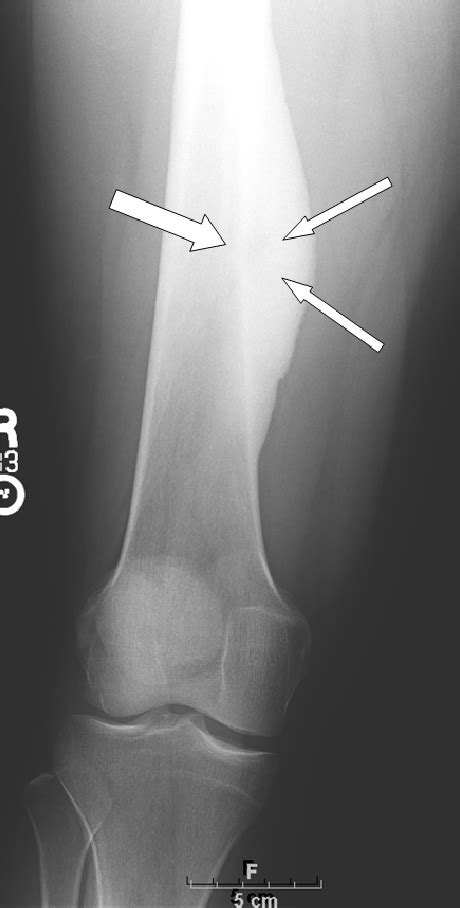 Figure From Osteoid Osteoma Semantic Scholar