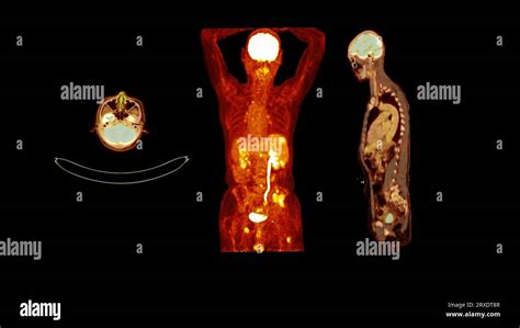 Pet Ct Image Of Whole Human Body Axial Coronal And Sagittal Plane