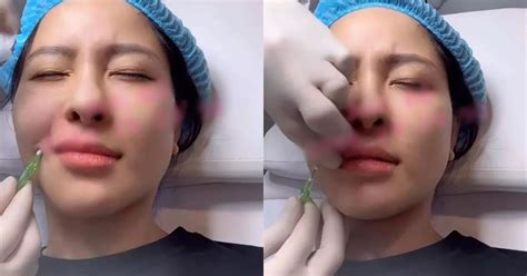 Hot girl Trâm Anh khoe cận cảnh thẩm mỹ khiến dân mạng rùng mình Hot KOLs Đời sống VGT TV