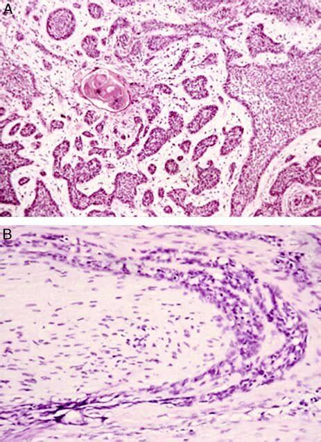 A And B Cutaneous Basal Cell Carcinoma A Basal Cell Carcinoma With