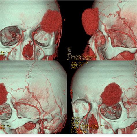 Angio Ct Three Dimensional Reconstruction Showing A Hyper Vascular