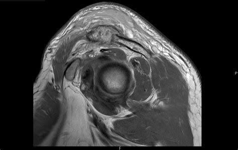 Septic Arthritis Of The Acromioclavicular Joint A Case Report Jetem