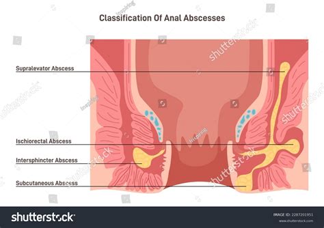 Discomfort Pain Anal Area Over 1 Royalty Free Licensable Stock Vectors