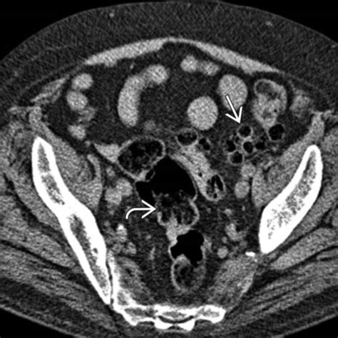 Colon Cancer Ct Scan Images Diverticulitis