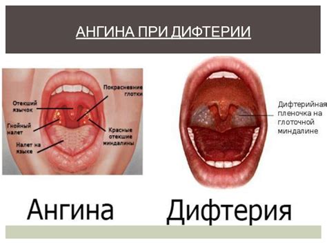 Ангины. Виды ангин