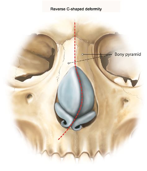 Illustration Of The Reverse C Shaped Nose Deformity The Septum And Download Scientific Diagram